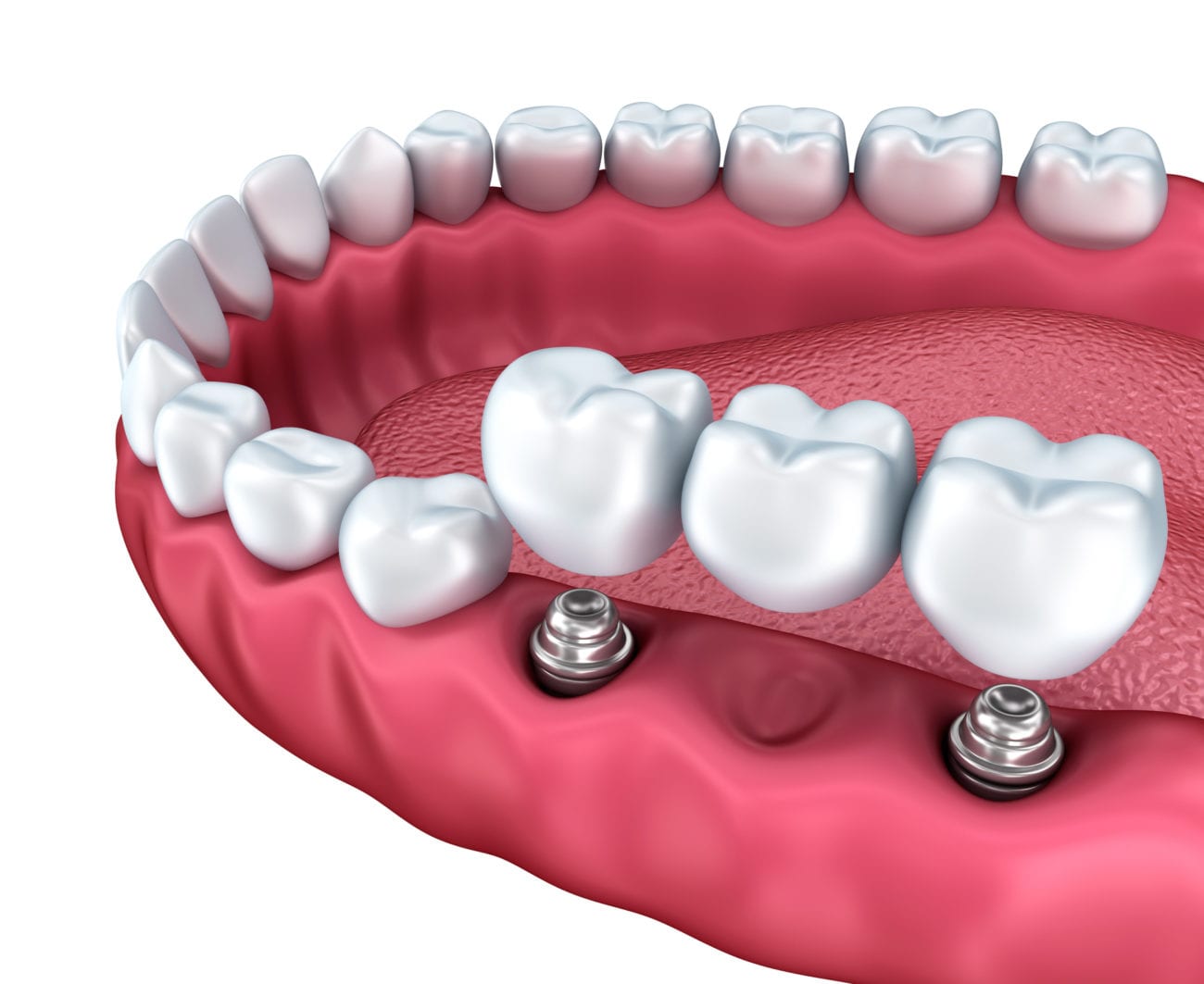 dental-bridge-evanston-il-missing-tooth-implant-bridge